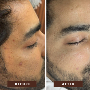 Smile Transformation 1