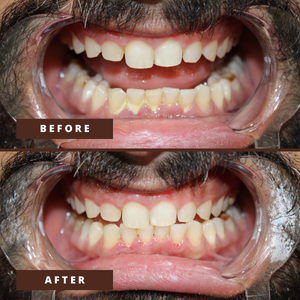 Smile Transformation 14