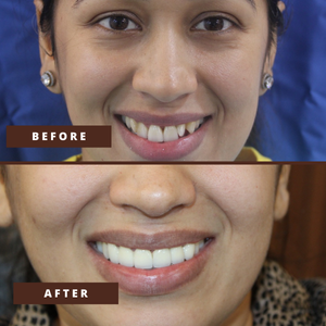 Smile Transformation 17