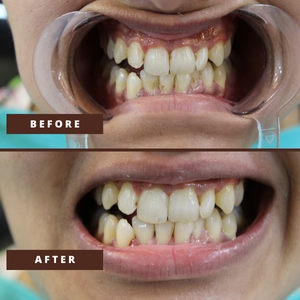 Smile Transformation 4